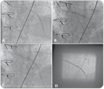 Percutaneous Coronary Intervention of A Diffusely Degenerated Saphenous Vein Graft