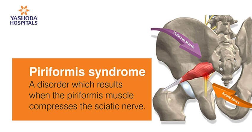 Managing piriformis syndrome requires a comprehensive approach