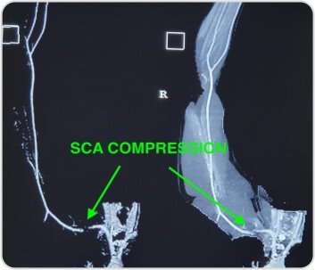 Right Arterial TOS (Thoracic Outlet Syndrome) Decompression by Cervical Rib Excision for Acute Upper Limb Ischemia