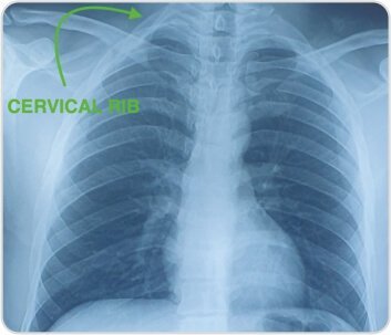 Right Arterial TOS (Thoracic Outlet Syndrome) Decompression by Cervical Rib Excision for Acute Upper Limb Ischemia