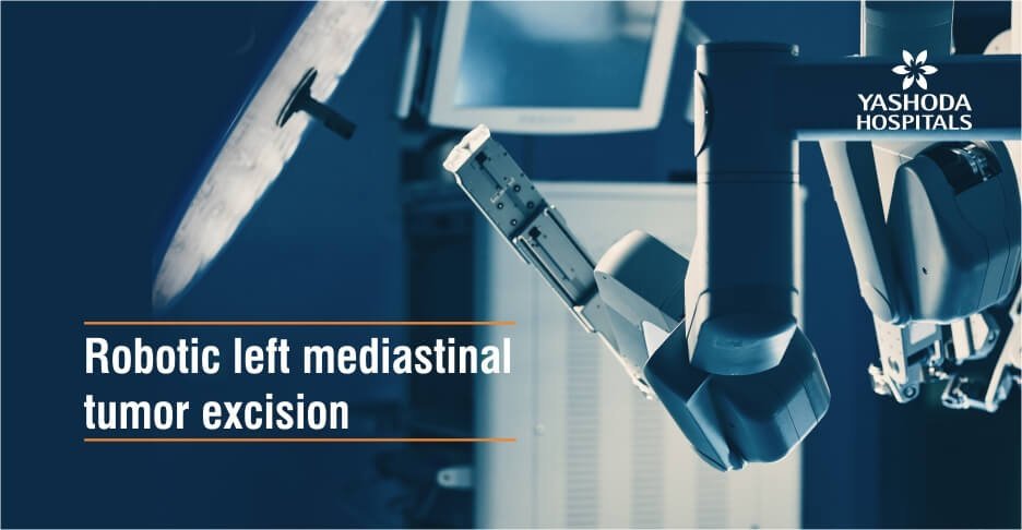 Robotic left mediastinal tumor excision