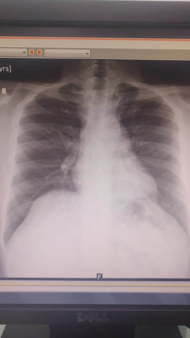 Robotic left mediastinal tumor excision