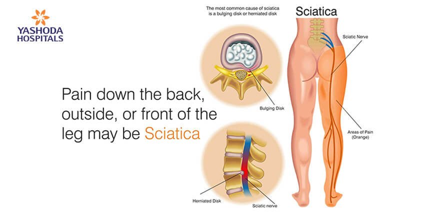 Sciatica Causes,Risk factors and Complications