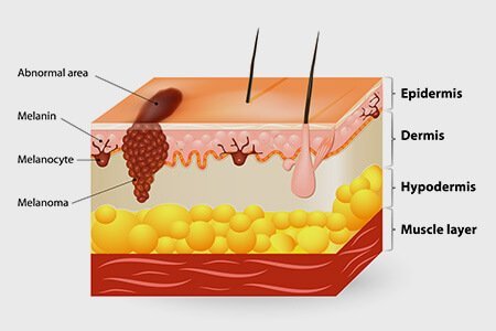 What is Skin Cancer or Melanoma