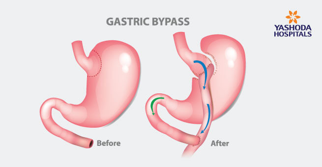 Sleev gastrectomy