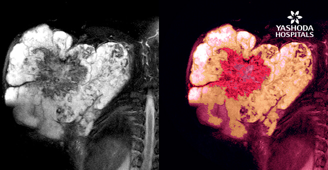 Soft tissue malignant tumor sarcoma mri