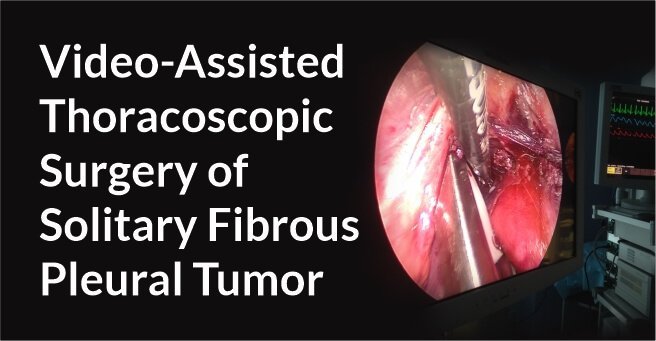 Video-Assisted Thoracoscopic Surgery of Solitary Fibrous Pleural Tumor