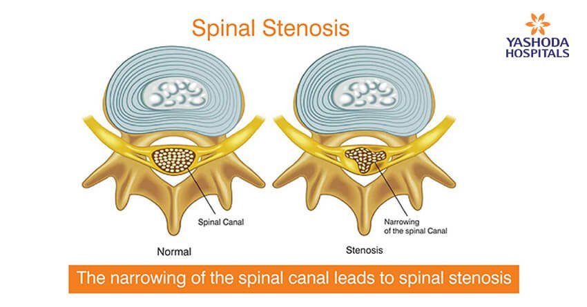 Lumbar and Cervical Spinal Stenosis