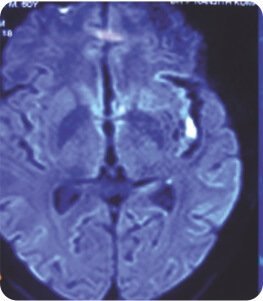 Symptomatic Carotid Near Total Occlusion Treated by Carotid Stenting