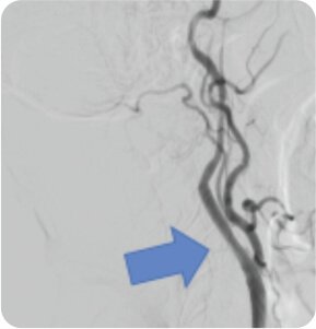 Symptomatic Carotid Near Total Occlusion Treated by Carotid Stenting