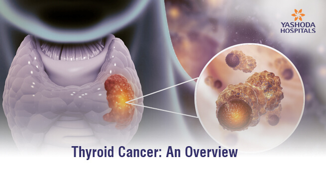 Thyroid Cancer