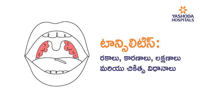 Tonsillitis Types, Symptoms & Treatment_Main