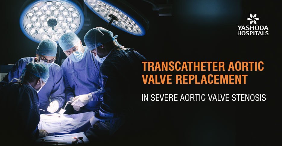 Transcatheter Aortic Valve Replacement (TAVR) for severe aortic valve stenosis