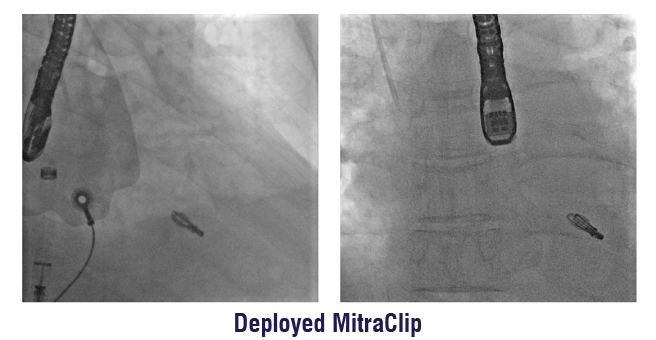 Transcatheter Mitral Valve Repair