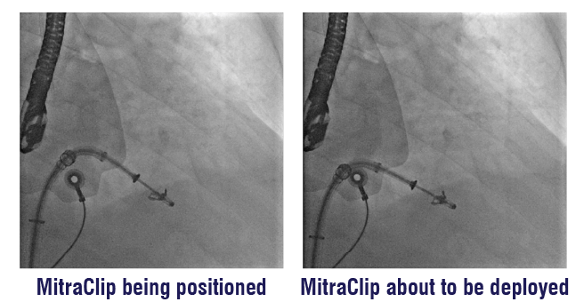 Transcatheter Mitral Valve Repair