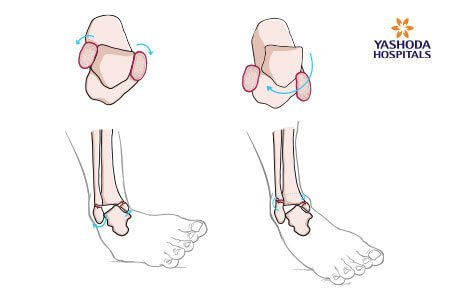 Vertical Talus What is Vertical Talus, its Causes