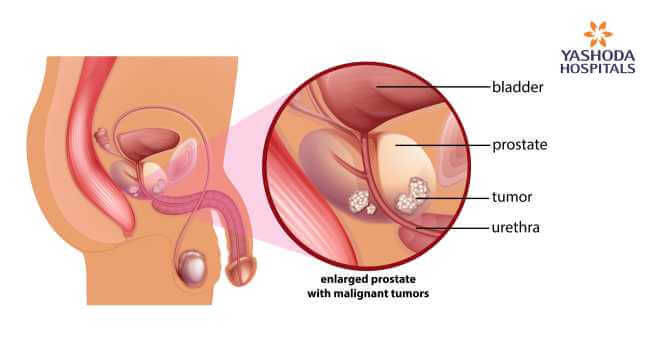 What Is Prostate Cancer