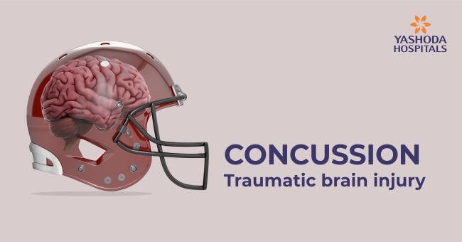 What is a concussion