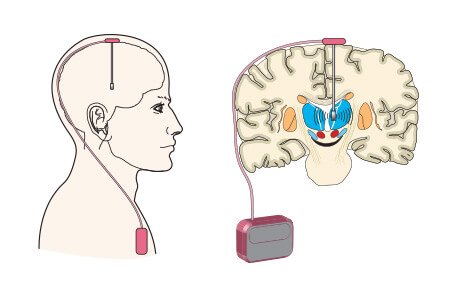 Procedure of DBS surgery