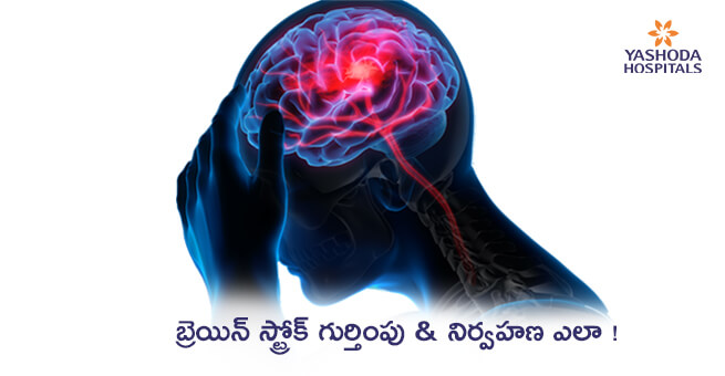 బ్రెయిన్ స్ట్రోక్