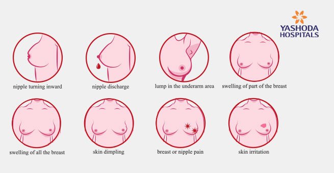 symptoms of breast cancer