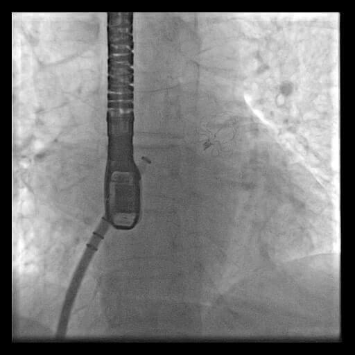 device for atrial fibrillation