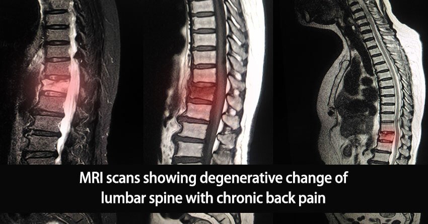 How to diagnose facet joint arthropathy