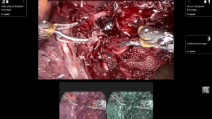 intraoperative biopsy