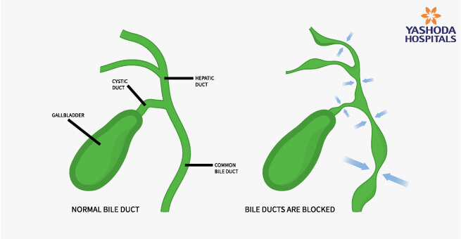 liver-cirrhosis1