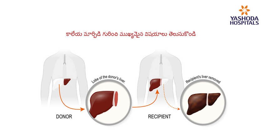 liver-transplant