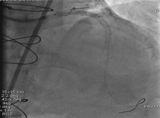 lmca to lad crossover stenting using r.onyx stent 3.5* 30 mm across the lcx