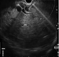 periampullary carcinoma EUS guided biliary access