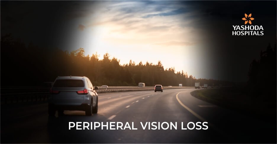 peripheral vision loss