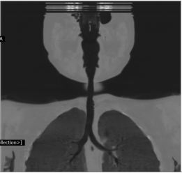 fiberoptic bronchoscopy