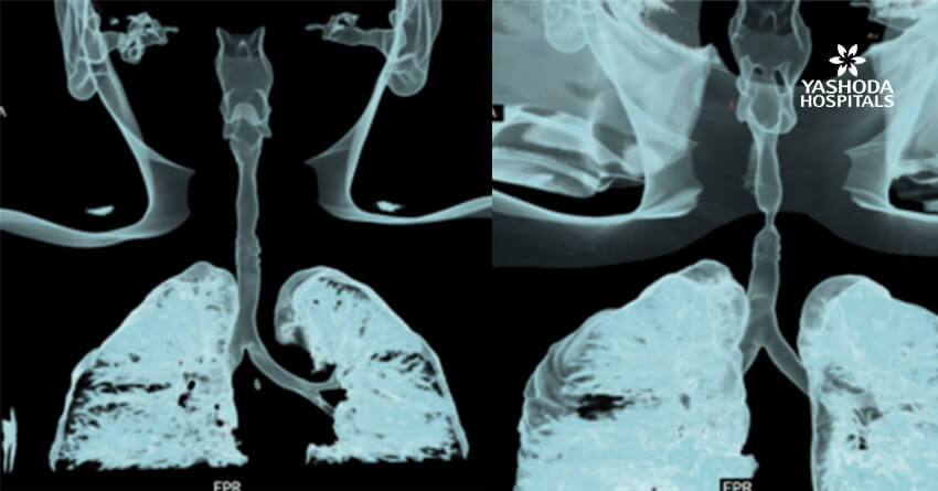 rigid bronchoscopic balloon bronchoplasty