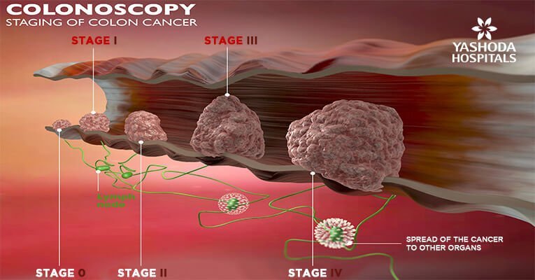 the screening recommendations for the early detection of colon and rectal cancer and polyps