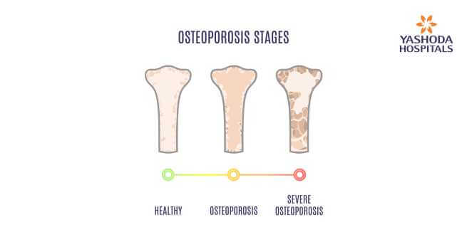 secondary osteoporosis