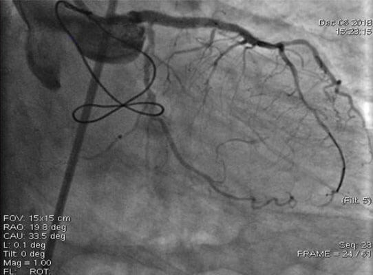 final image: successful done ptca lmca