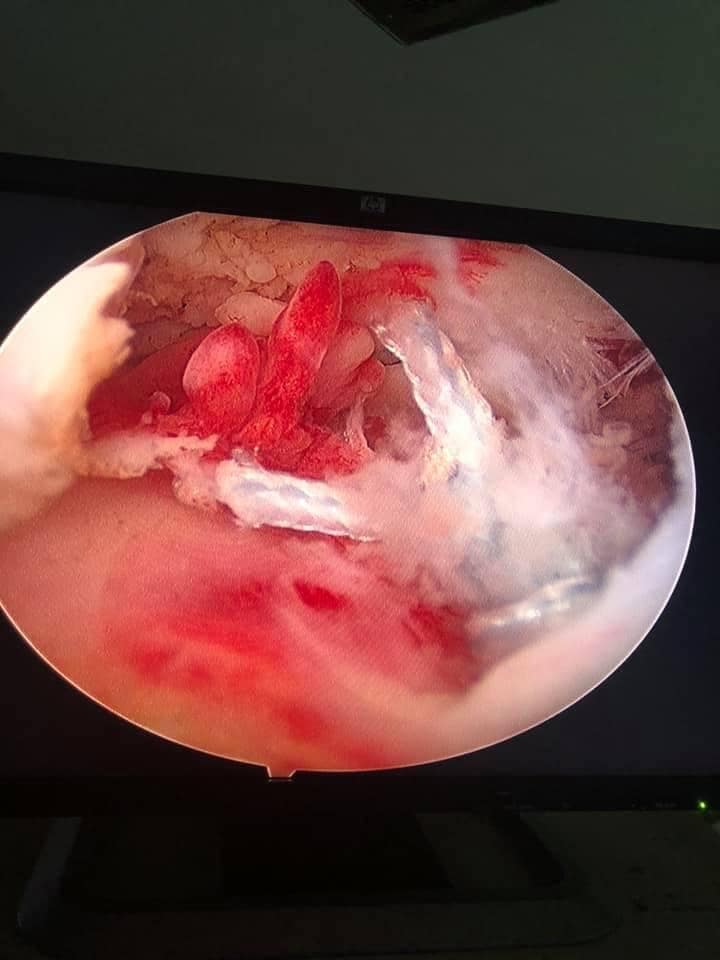 Arthroscopy for torn rotator cuff