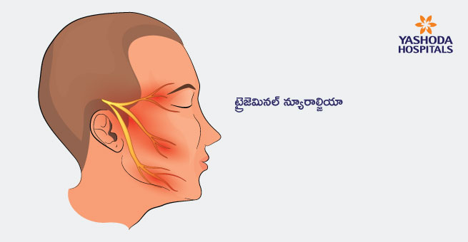 Trigeminal Neuralgia