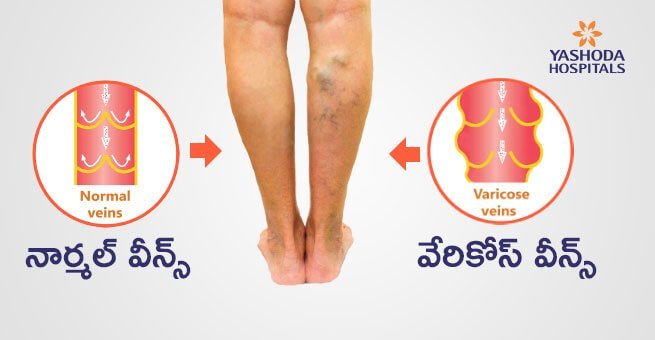 varicose veins in telugu